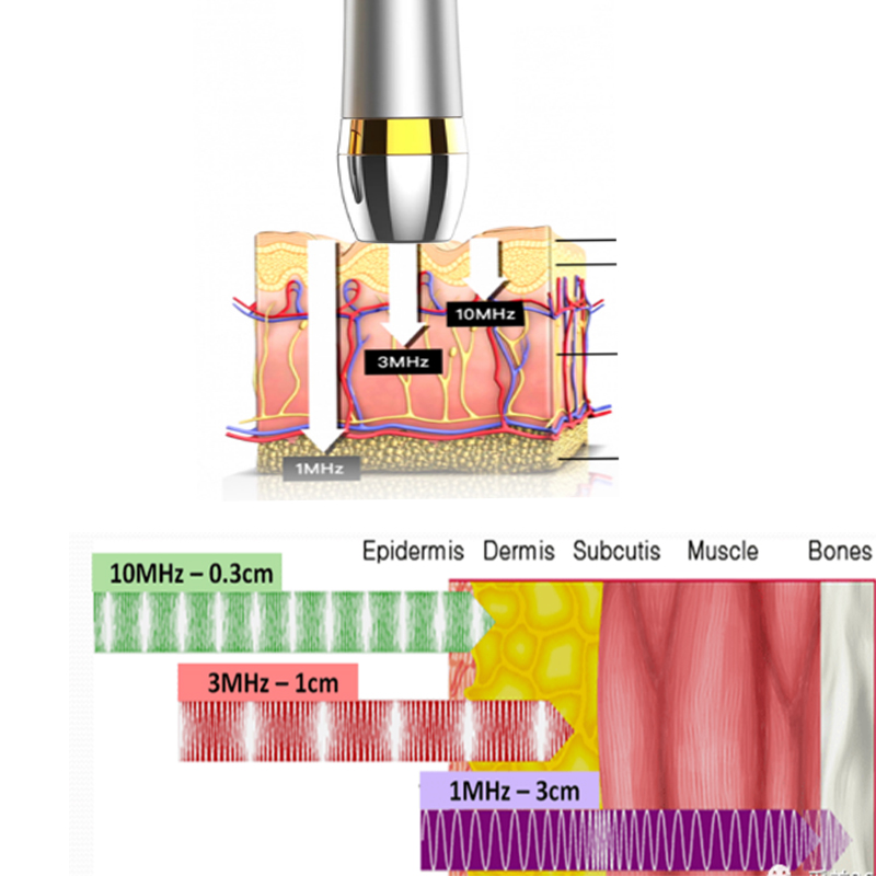 L'instrument de beauté ultrasonique 10 MHz développé par la société